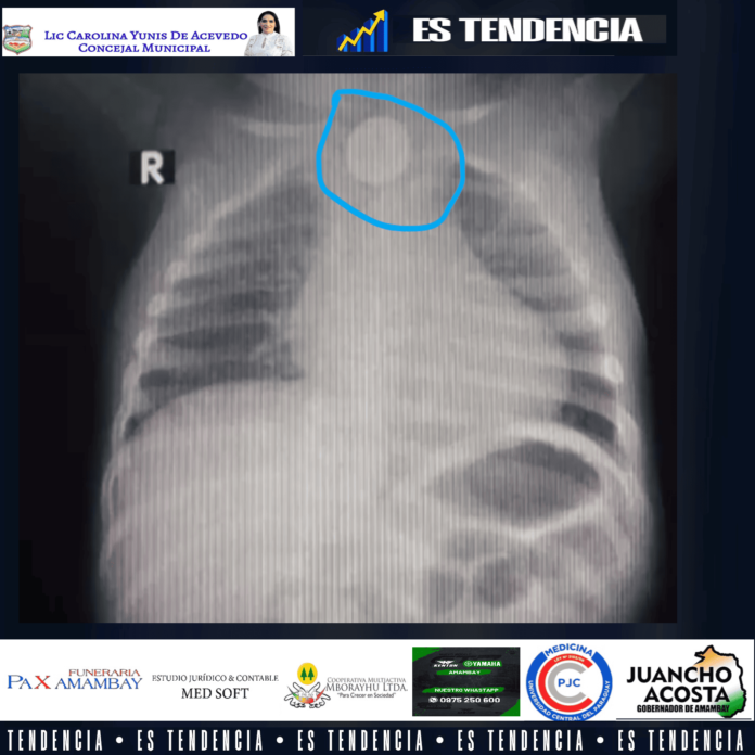 Niño de un año tragó una pila y debe someterse a urgente cirugía.